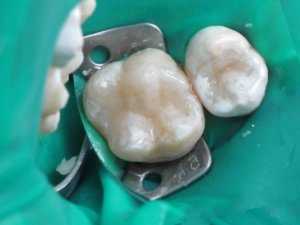 Цементная пломба