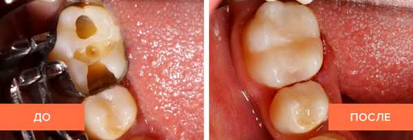 Фото пациента до и после установки пломбы зуба