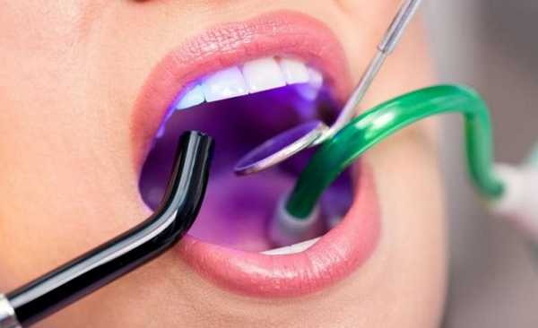 композитная пломба