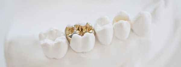 металлические пломбы