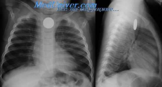 Эзофагография при атрезии пищевода