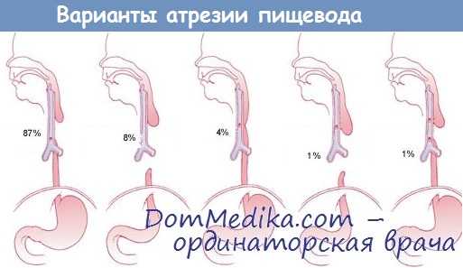 Атрезия пищевода