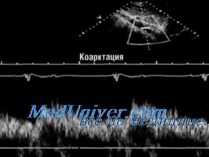 коарктация аорты