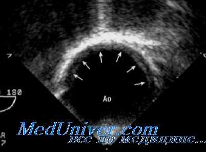 разрыв аорты