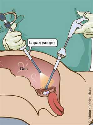 Лапароскопия