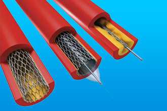 Аортокоронарное шунтирование