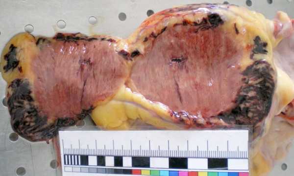 Причины разрыва сердца