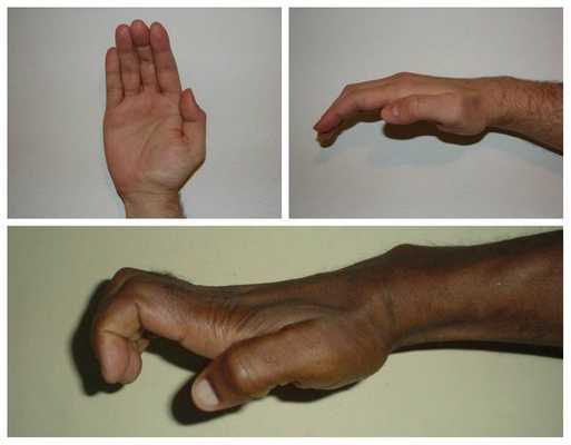 Осложнение синдрома запястного канала: 