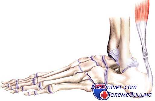 разрыв ахиллова сухожилия