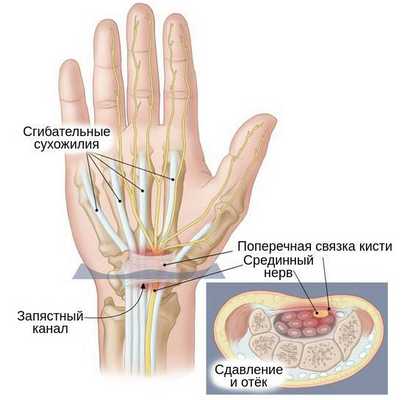 Запястный канал и сдавленный срединный нерв