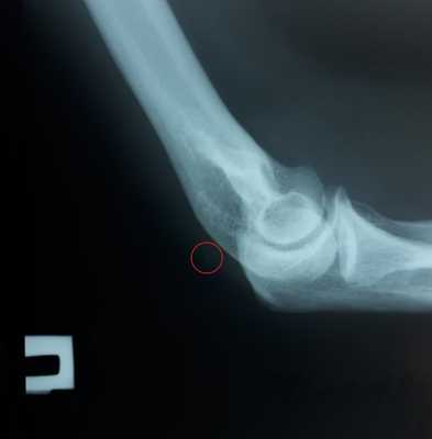 отрыв трицепса рентген