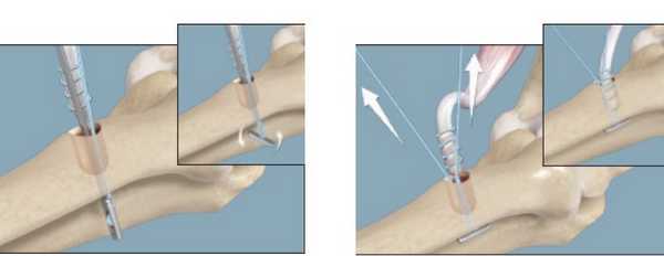 шов бицепса схема