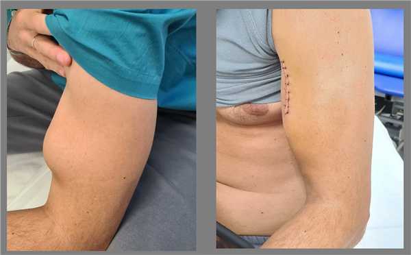 отрыв проксимального бицепса