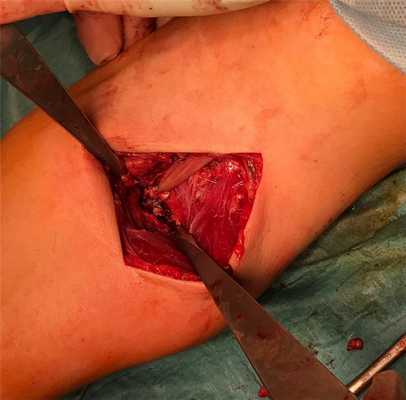 шов бицепса операция