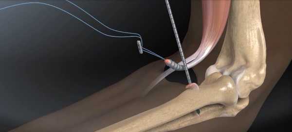 отрыв бицепса плеча техника операции