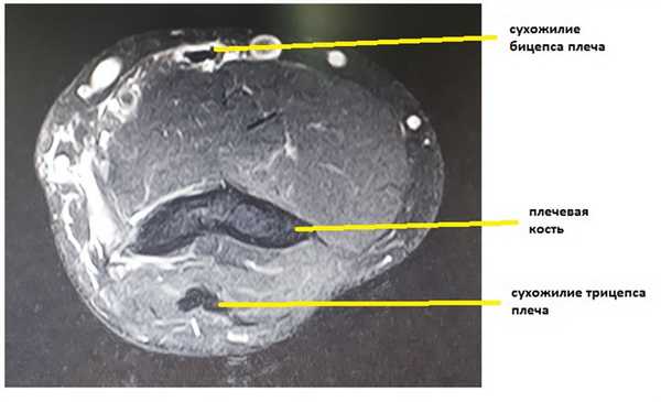 отрыв бицепса МРТ