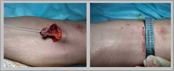 разрыв бицепса