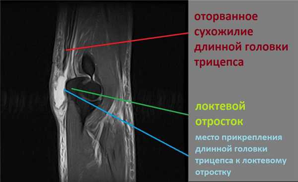 отрыв трицепса мрт