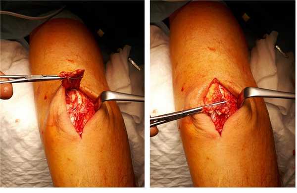 отрыв трицепса операция