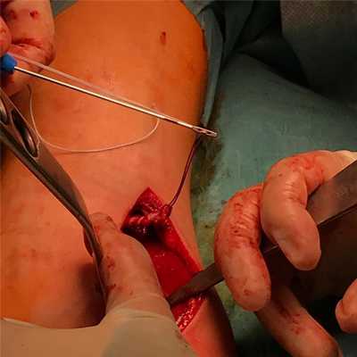 операция при отрыве бицепса