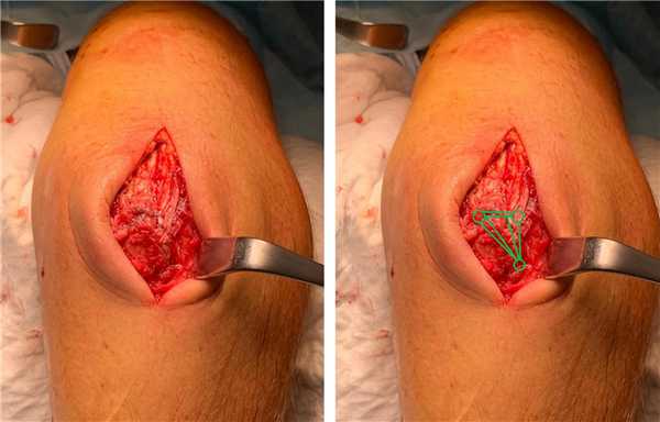 операция при отрыве трицепса якорные фиксаторы