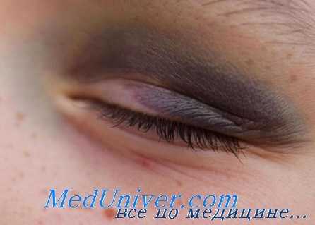 контузия радужки и цилиарного тела