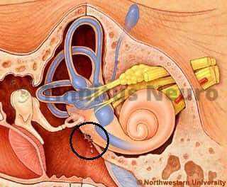 Отверстие в канальце - причина шума в ушах