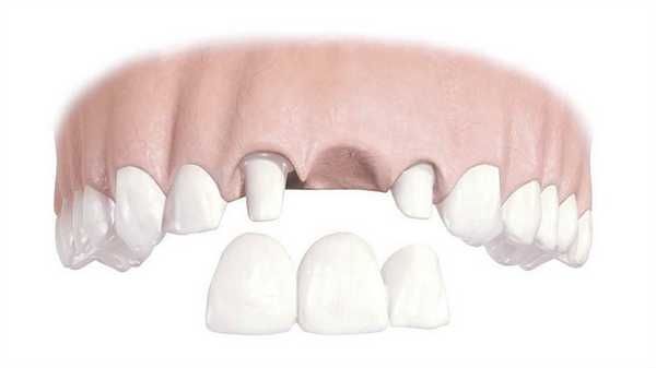 Несъемные зубные протезы