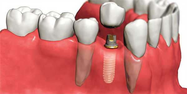 Протезирование без обтачивания соседних зубов
