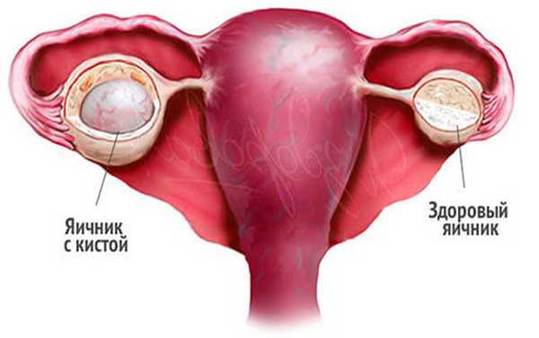 Яичник с кистой