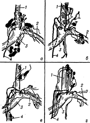 Рис. 2. Схема некоторых вариантов изменчивости шейной части грудного протока: а — один ствол; б — два ствола; в — три ствола; г — четыре ствола; 1 — у. jugularis int.; 2 — v. subclavia sin.; 3 — v. brachiocephalica sin.; 4 — ductus thoracicus.