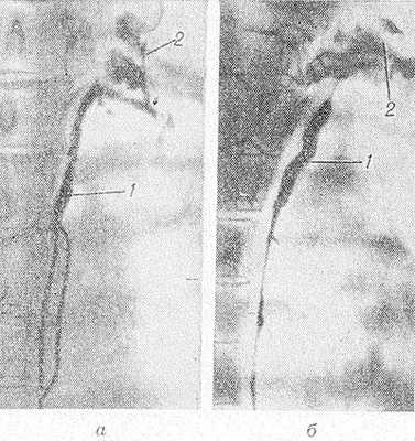 Рис. 3. Томограммы грудного протока (а— прямая, б — боковая проекции): грудной проток (1) на уровне Т4—Т5 делится на два ствола, видна группа надключичных лимфатических узлов (2).