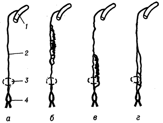 Рис. 1. Схема некоторых вариантов изменчивости грудной части грудного протока: а — один ствол; б—г дополнительный, левосторонний проток на разных участках; 1 — вена; 2 — грудная часть протока; 3 — область аортального отверстия в диафрагме; 4 — млечная цистерна.