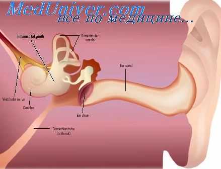 лабиринтит