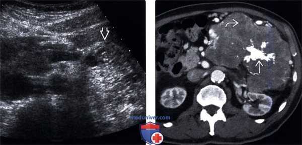 УЗИ, КТ серозной цистаденомы поджелудочной железы