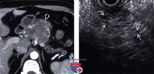 УЗИ, КТ серозной цистаденомы поджелудочной железы