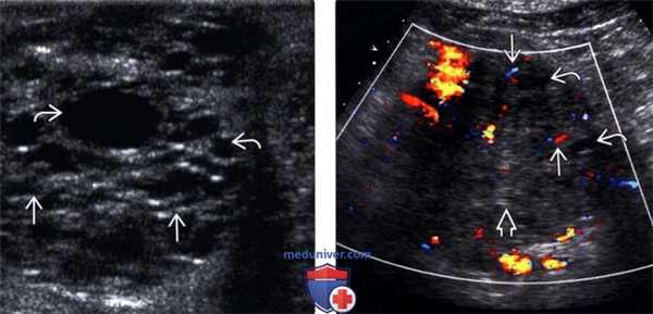 УЗИ, КТ серозной цистаденомы поджелудочной железы