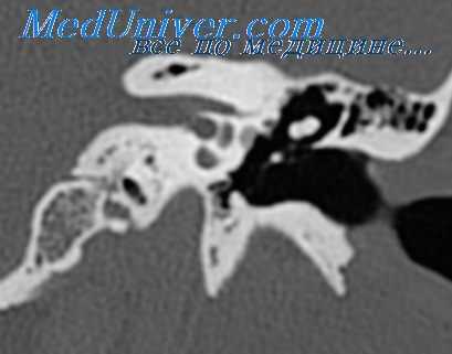 отоспонгиоз и отосклероз