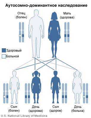 Отосклероз