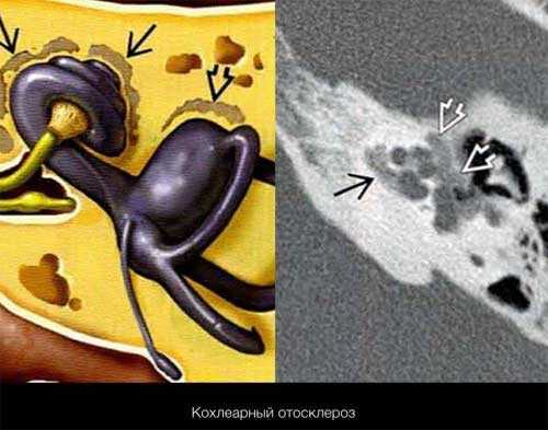 Отосклероз