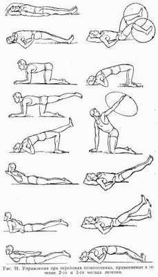 Упражнения при переломах позвоночника