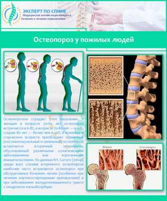 Остеопороз у пожилых людей