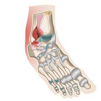 разрыв связок голеностопного сустава лечение