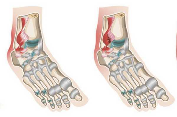 как лечить растяжение связок голеностопного сустава