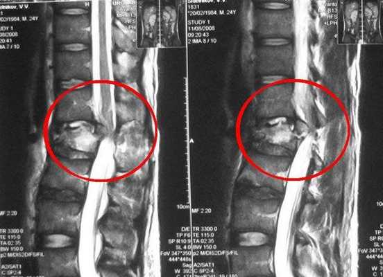 Перелом поясничного отдела позвоночника