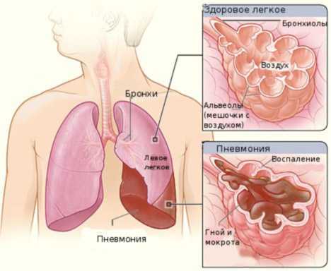 Pneumonia Пневмония легкие