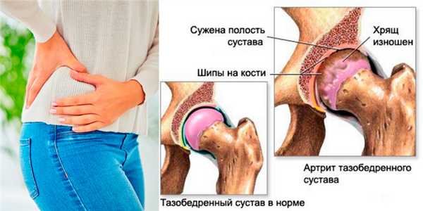 Осложнения острого артрита