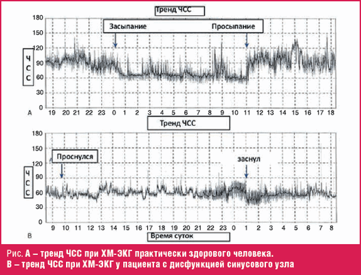 А - тренд ЧСС при ХМ-ЭКГ практически здорового человека. В - тренд ЧСС при ХМ-ЭКГ у пациента с дисфункцией синусового узла