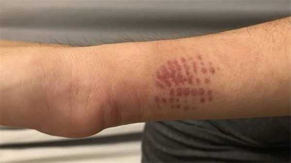 Ожог от гусеницы-кота