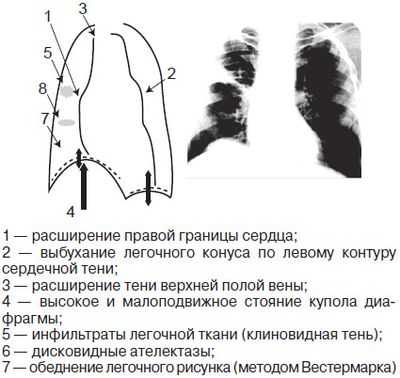 Первичная лёгочная гипертензия
